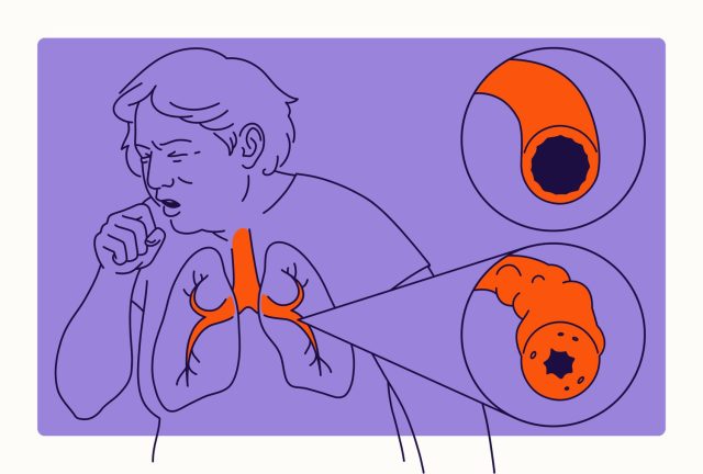 Bệnh phổi tắc nghẽn mạn tính xảy ra do hẹp đường thở