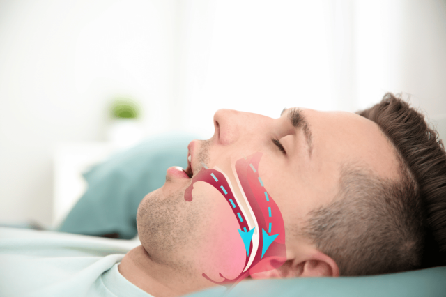 Ngáy to là biểu hiện thường thấy nhất của chứng ngưng thở khi ngủ