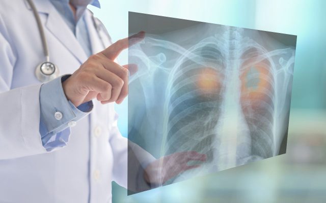 Chụp X-quang là phương pháp giúp phát hiện bệnh phổi tắc nghẽn mạn tính