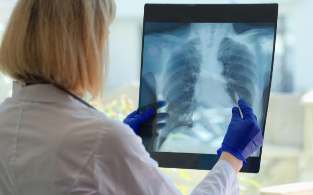 Bệnh tim mạch có mối liên hệ với bệnh COPD