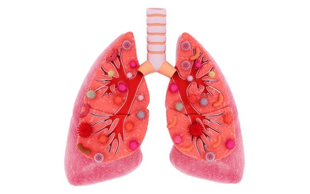 Nhiễm trùng phổi thường do sự xâm nhập của các loại vi khuẩn