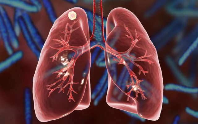 Triệu chứng COPD thường bị nhầm lẫn với nhiều loại bệnh hô hấp khác
